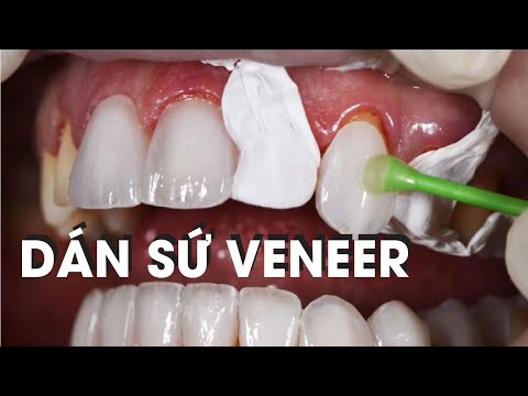 Dán sứ Veneer