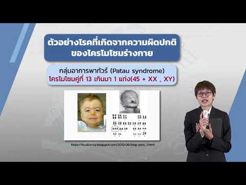 วีดีโอ: กลุ่มอาการ trisomy 8 คืออะไร?