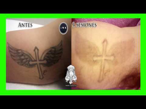 Vídeo: Los Trucos Caseros Para La Eliminación De Tatuajes Son Ineficaces Y Peligrosos