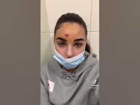 Что может быть если неправильно выдавить прыщ - YouTube