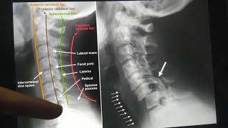 Distraction type subaxial cervical fractures