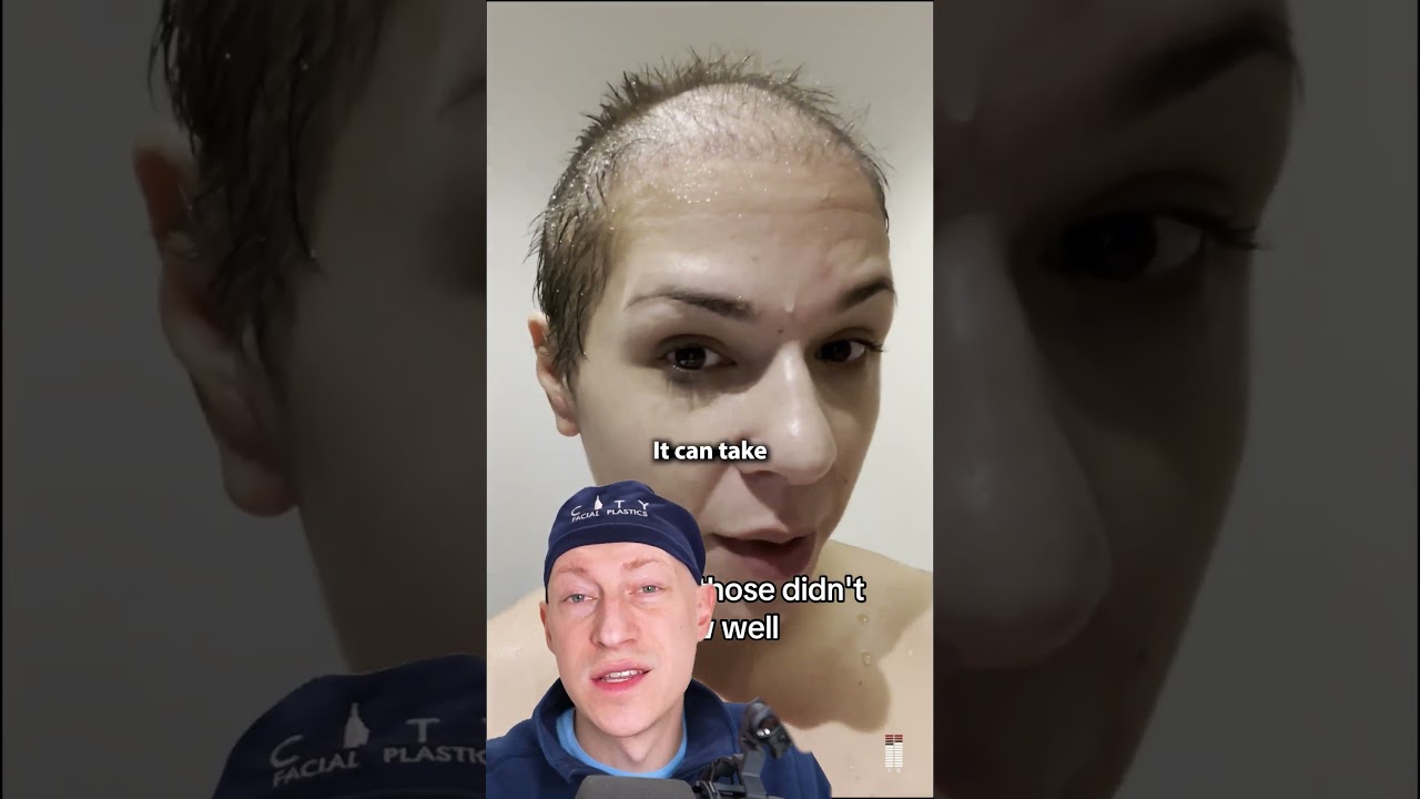 Female Hair Transplant GONE WRONG?