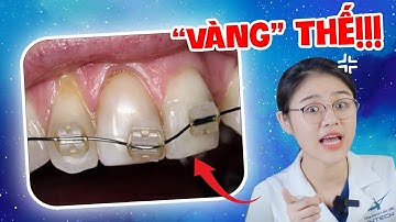 Niềng Răng Mắc Cài Pha Lê: Niềng Răng Mắc Cài Pha Lê Liệu Có "Đáng Đồng Tiền"? (Bác Sĩ Đánh Giá)