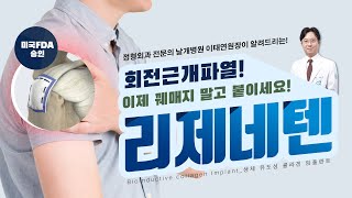 어깨통증｜회전근개 힘줄 파열 치료의 혁신적인 새로운 수술적 치료법 ｜리제네텐