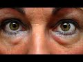 Remedio para las bolsas de ojos y  ojeras oscuras