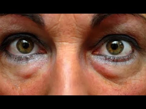 Video: Tendencia De Belleza Inesperada: Los Tiktokers Se Dibujan Bolsas Debajo De Los Ojos