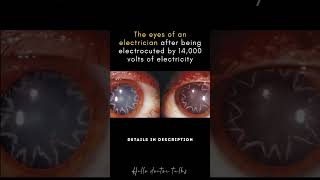The eyes of an electrician after being electrocuted by 14,000 volts of electricity #healthchannel