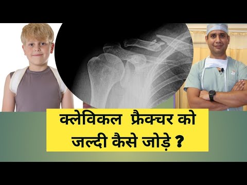 क्लेविकल का फ्रैक्चर सही कैसे करे/  collar bone fracture  surgery  yes/ no Natural healing /