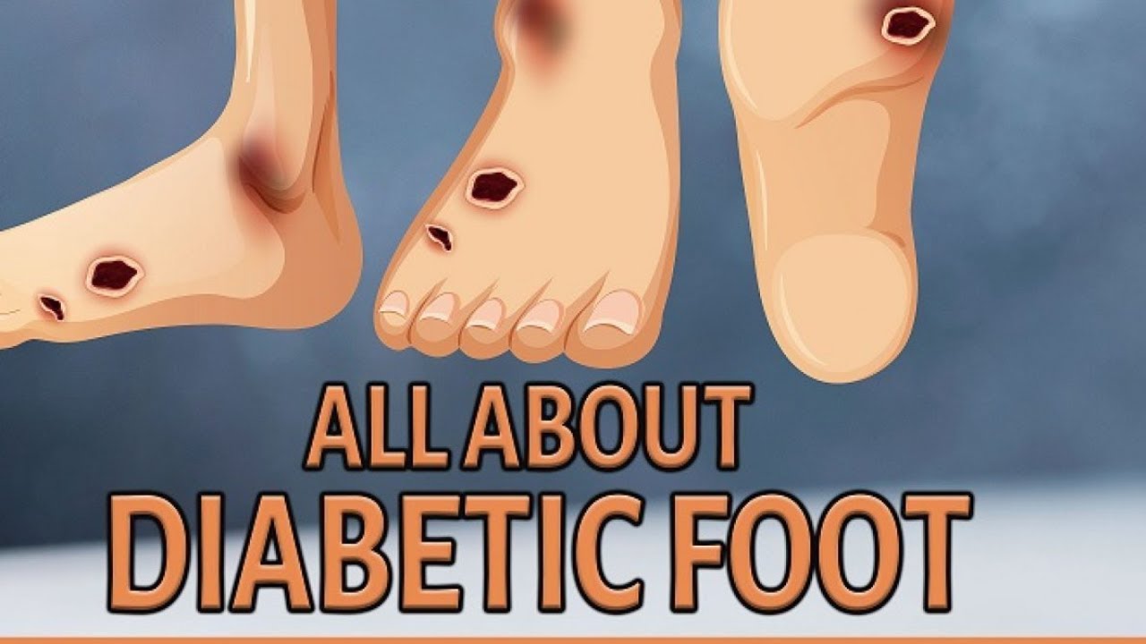 management of diabetic foot in Malayalam.... YouTube