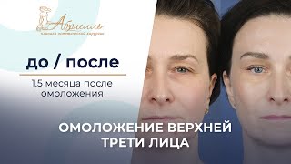 Как выглядит лицо после подтяжки? Омоложение лица 1,5 месяца после операции #Кочнева #Абриелль #СПб