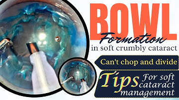 Bowl formation in soft crumbly cataract, Tips for soft nucleus management: Dr. Deepak Megur