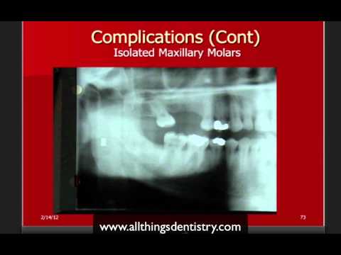 Oral Surgery Hints - Surgical Complications, I&D