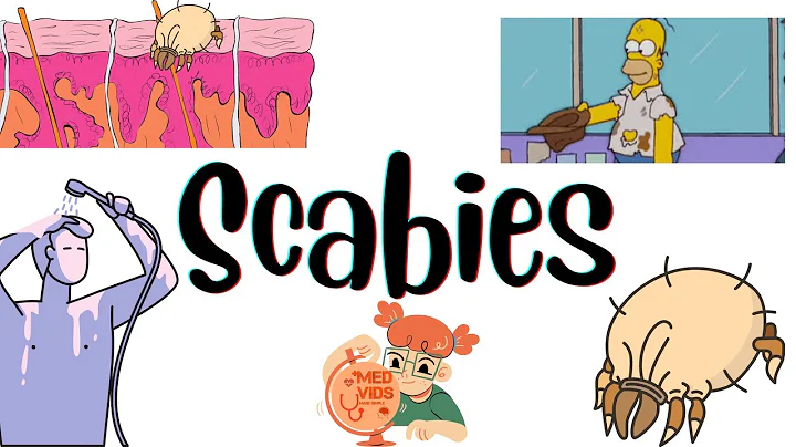 Scabies | Dermatology (Pathophysiology,clinical features,diagnosis,treatment) MedVidsMadeSimple