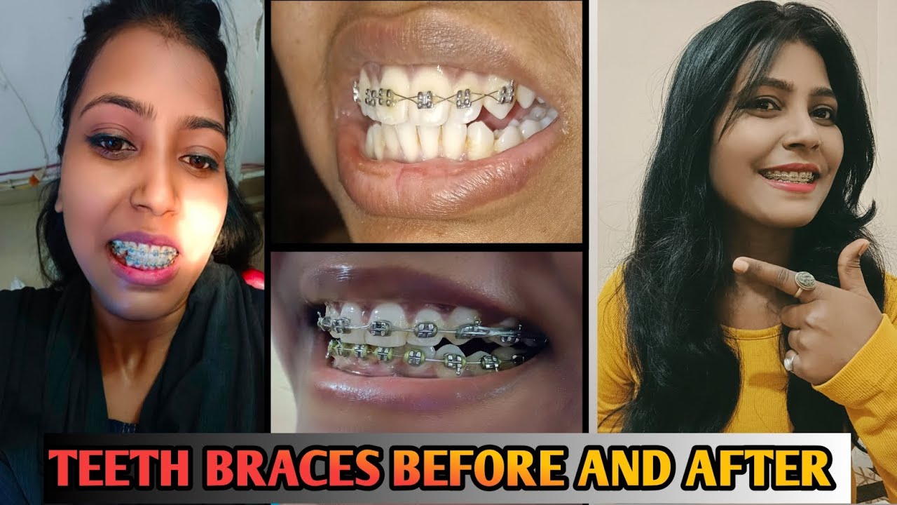 Braces Journey 😊 || Teeth Braces Before And After || Braces Update ...
