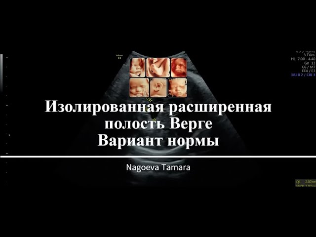 Расширенная полость Верге