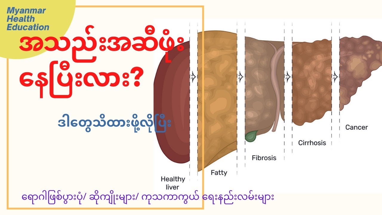 အသည်းအဆီဖုံးရောဂါ Fatty Liver အကြောင်းသိကောင်းစရာ