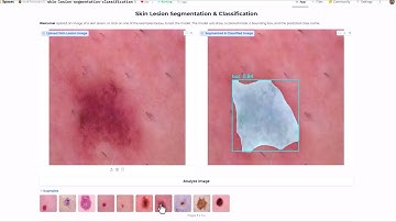 AI Meets Dermatology – Skin Lesion Detection & Classification