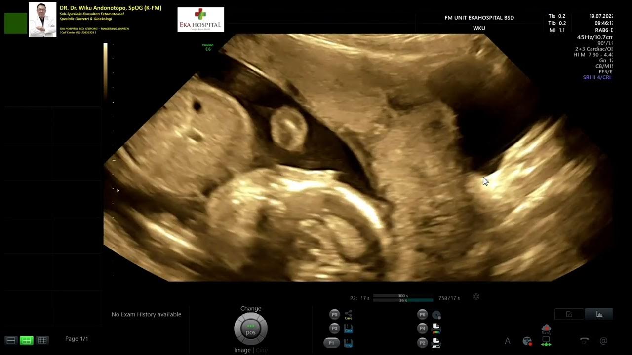 Plasenta Previa Totalis PERCRETTA menembus blaader (Dr Wiku Andonotopo) YouTube