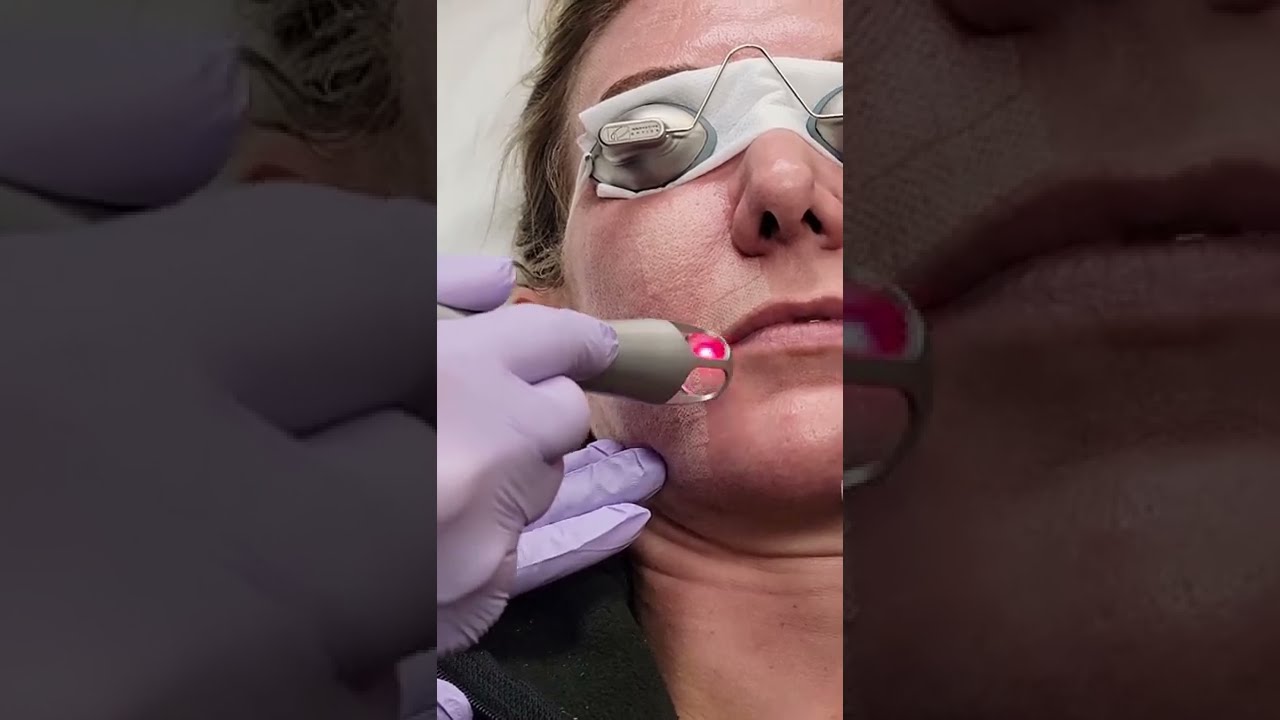 Brian Biesman M.D, UltraClear Treatment Video