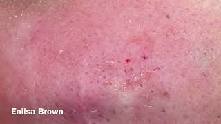 Blackheads Extractions/ Christian Part 2