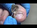 Bad nails are pulled out and need to grow back【Pedicure Master Lin Jun】