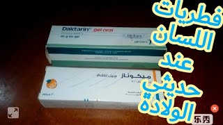 علاج فطريات اللسان عند الأطفال الرضع.