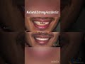 Beautiful Smile Transformation | E-Max Pure Ceramic Crowns | Dental Excellence Mohali