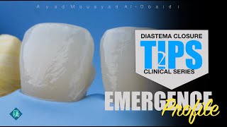 diastema closure technique tips