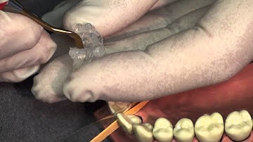 Class IV Light-Cured Composite Time Saving Technique