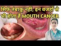 सिर्फ तंबाकू नहीं, इन वजहो से होता है MOUTH CANCER