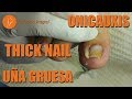 Thick nail (Onicauxis) [Podología Integral] #podologiaintegral