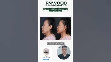 Dr. Ryu’s DEEP PLANE FACELIFT & NECKLIFT | CASE 10 (Age 69)