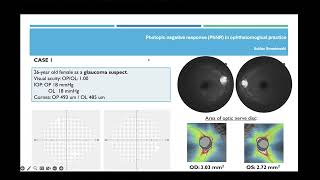 PhNR en el Glaucoma