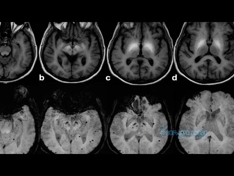 ნარკოდამოკიდებულება და მისი ნეგატიური ზეგავლენა თავის ტვინზე