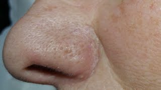 Nose Extractions