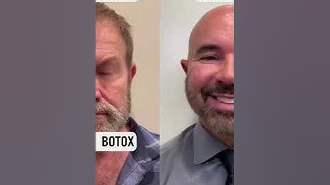 2 Week Update | Daxxify Split Face Trial #shorts #short