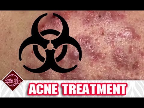 Cystic Acne, Pimples And Blackheads Extraction Acne Treatment On Face This Week #