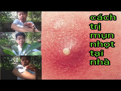 Cách trị mụn nhọt ở mông/trị mụn nhọt ở cằm ,ở mặt bằng mủ cây sứ hiệu quả và dễ làm