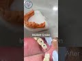 Dental Implant in Nagpur | Implant-Supported Zirconia Crown Transformation 🦷✨ | Dr. Vandana Upwanshi