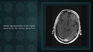 VBrain - the FDA-cleared tumor auto-contouring AI solution