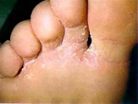 Bicarbonato Para Los Hongos de los Pies
