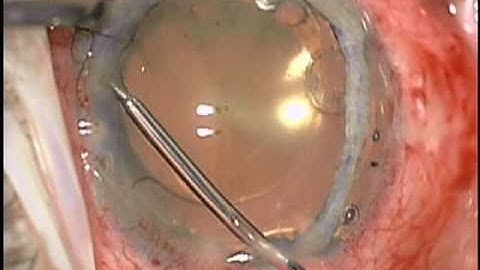 Baseer U. Khan, MD: Dislocated Cataract Extraction, (CTS), Iridodialysis Repair and Pupil Cerclage