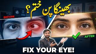 Aankhon Ka Bhenga Pan Kyun Hota Hai? - Eye Squint Causes & Treatment -Bhengapan Ka Ilaj