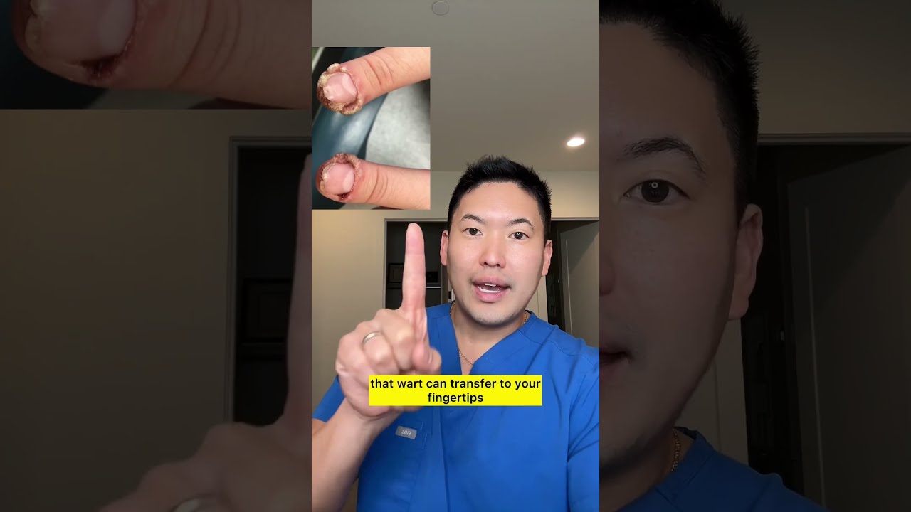 Everything You Need To Know About Plantar Warts