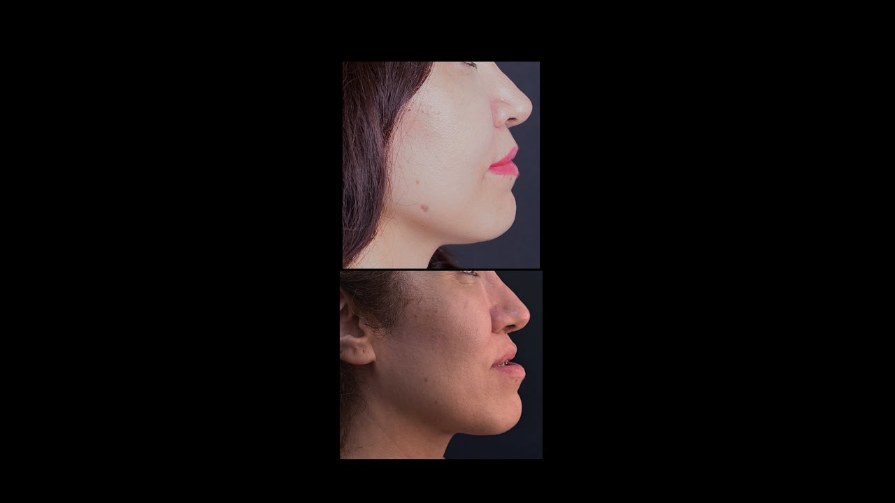 Çene Ameliyatı Deneyimi-Ortognatik Cerrahi Sonrası 4. Ay