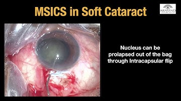 Management of Soft Cataract