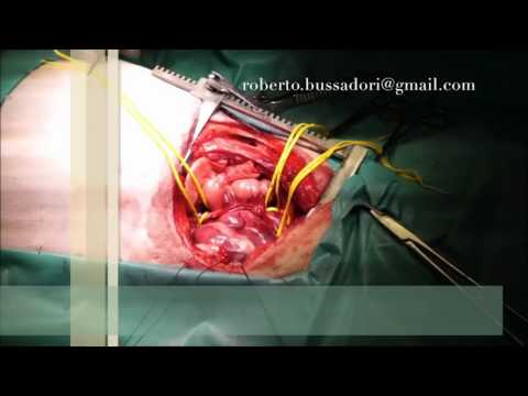 Video: Tumori Cardiaci (miocardio) Nei Cani