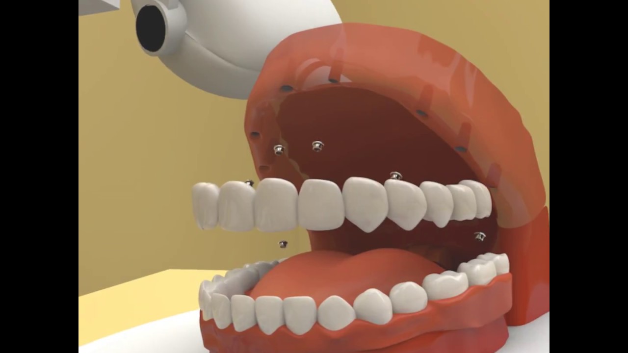Prótesis fijas con implantes dentales