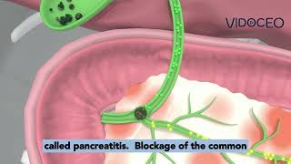 Choledocholithiasis explained