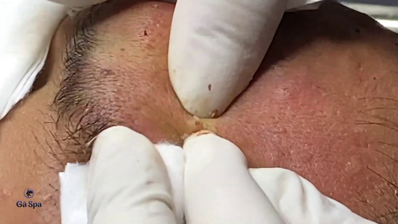 SIGNATURE SERVICE: Acnes Treatment (Ver.5)